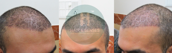 Hair Growth after 10 Days